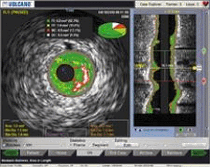 Image: The LipiScan IVUS demonstrating plaque types in a coronary artery vessel (photo courtesy InfraReDx).